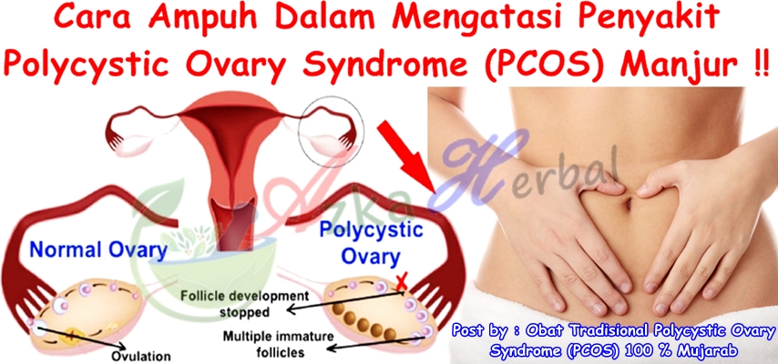 Obat Tradisional Polycystic Ovary Syndrome (PCOS) 100 % Mujarab